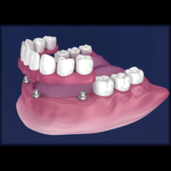 The anchoring of a crown bridge or denture