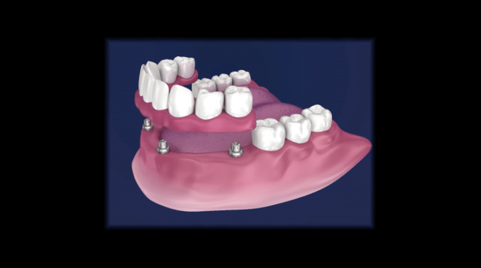 The anchoring of a crown bridge or denture