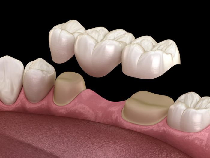 The anchoring of a crown bridge or denture